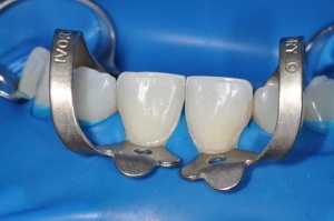 Особенности коффердама в стоматологии